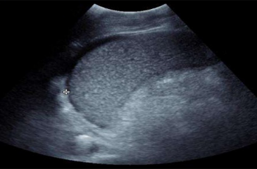 Spleen Ultrasound