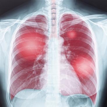 illustration of xray showing damaged lungs